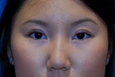 Asian / Ethnic Surgery Before & After Gallery - Patient 161441 - Image 2