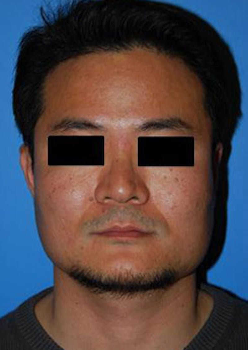Asian / Ethnic Surgery Before & After Gallery - Patient 891167 - Image 1