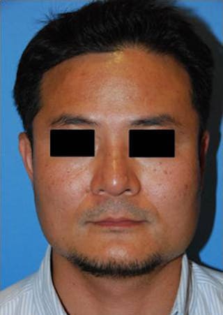 Rhinoplasty Before & After Gallery - Patient 273971 - Image 2