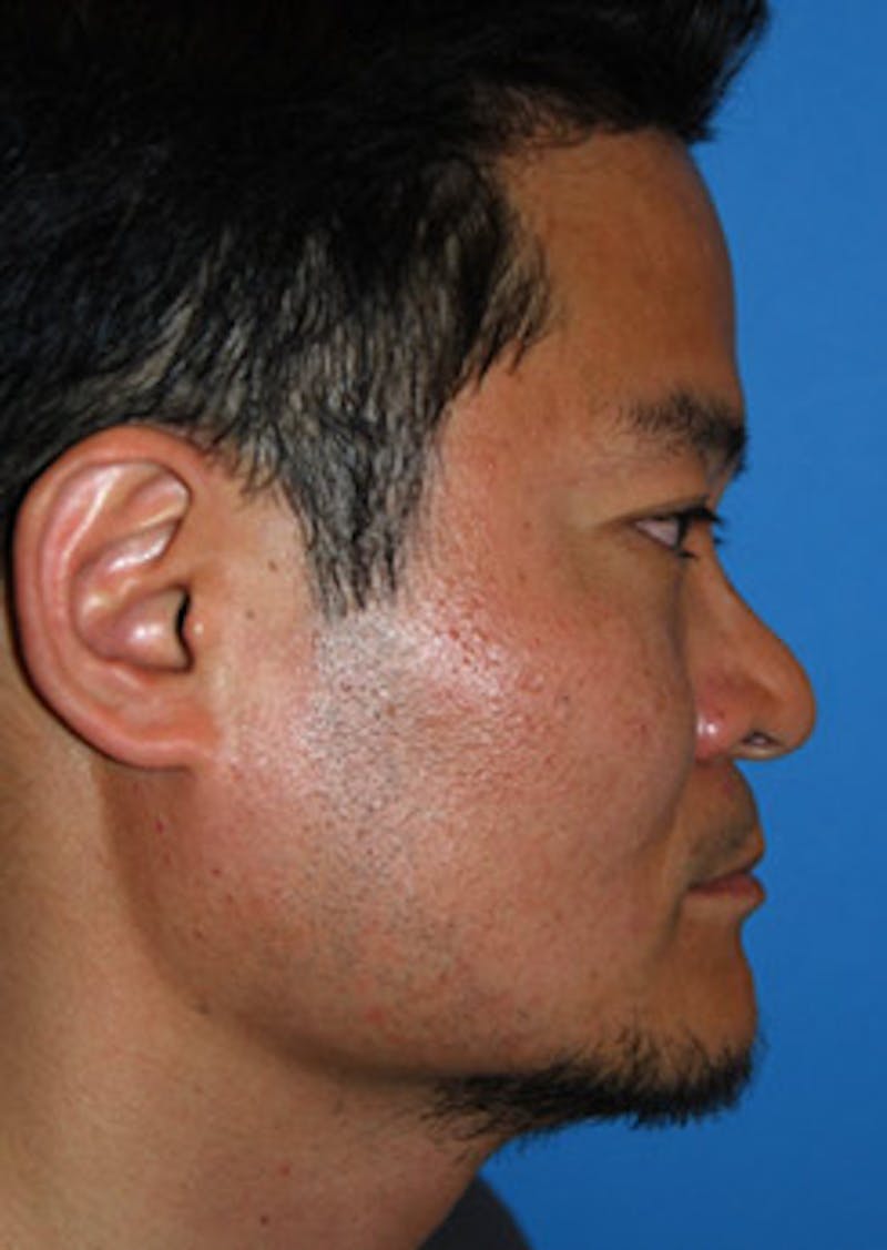 Asian / Ethnic Surgery Before & After Gallery - Patient 891167 - Image 3