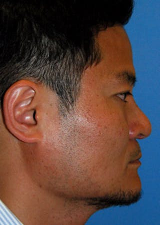 Rhinoplasty Before & After Gallery - Patient 273971 - Image 4