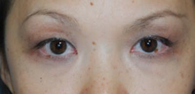 Asian / Ethnic Surgery Before & After Gallery - Patient 386588 - Image 1