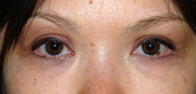 Asian / Ethnic Surgery Before & After Gallery - Patient 386588 - Image 2