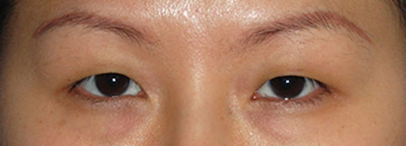 Asian / Ethnic Surgery Before & After Gallery - Patient 216442 - Image 1
