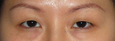 Asian / Ethnic Surgery Before & After Gallery - Patient 216442 - Image 1
