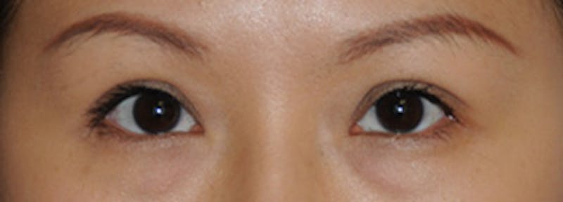Asian / Ethnic Surgery Before & After Gallery - Patient 216442 - Image 2