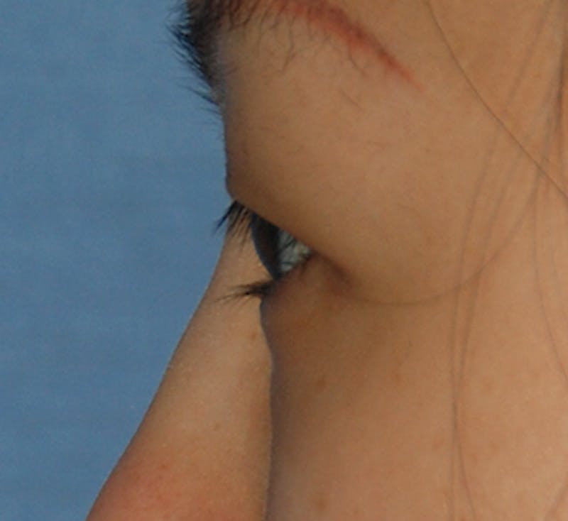 Asian / Ethnic Surgery Before & After Gallery - Patient 216442 - Image 3