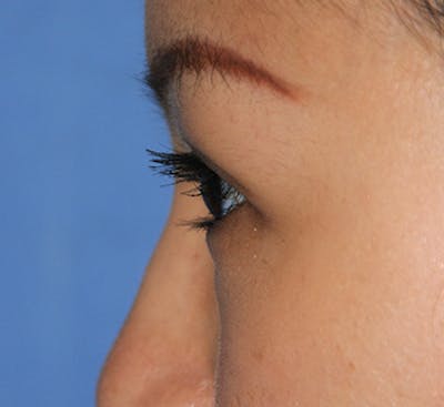 Eye Lift Before & After Gallery - Patient 259068 - Image 2