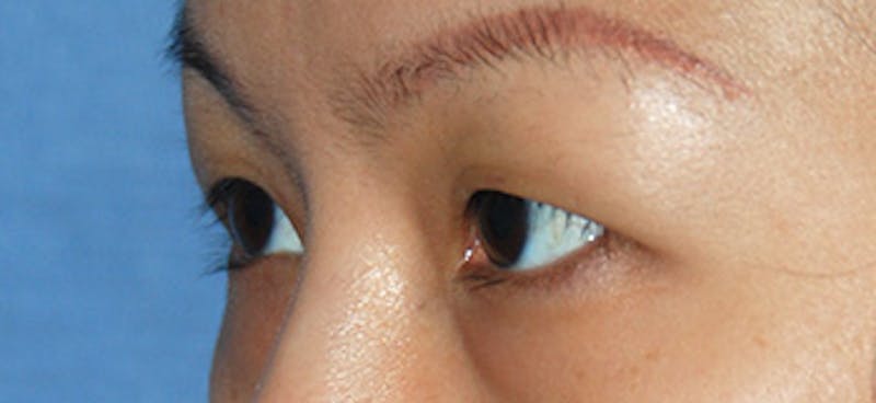 Asian / Ethnic Surgery Before & After Gallery - Patient 216442 - Image 5