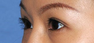 Eye Lift Before & After Gallery - Patient 259068 - Image 4