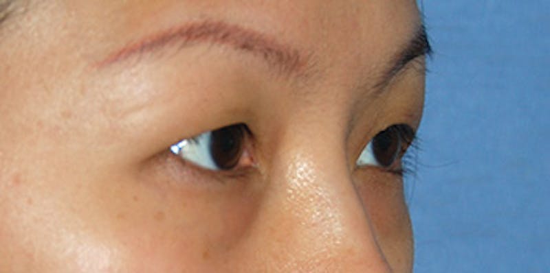 Asian / Ethnic Surgery Before & After Gallery - Patient 216442 - Image 7