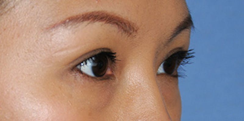 Asian / Ethnic Surgery Before & After Gallery - Patient 216442 - Image 8
