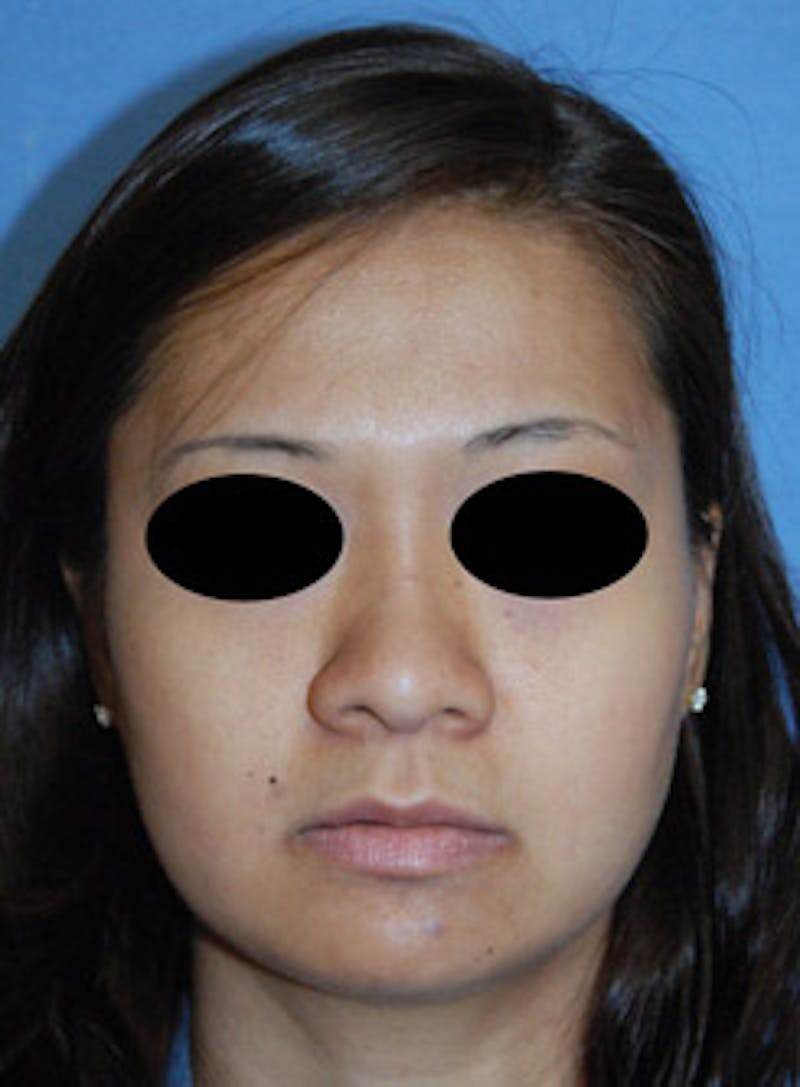 Asian Rhinoplasty Before & After Gallery - Patient 494587 - Image 1