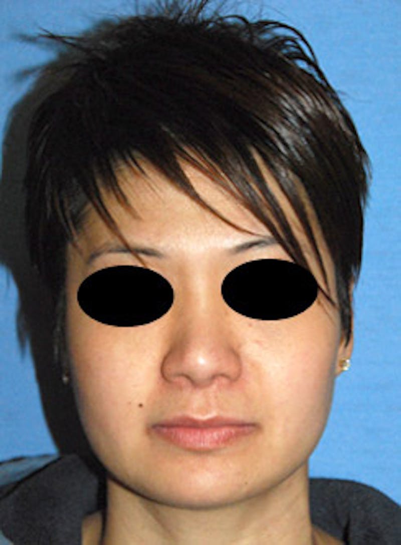 Asian Rhinoplasty Before & After Gallery - Patient 494587 - Image 2