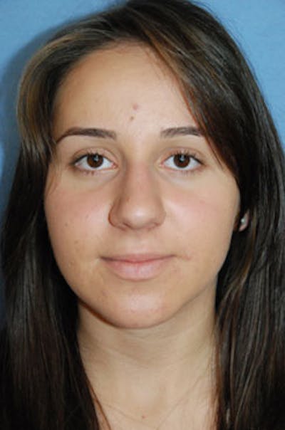 Asian Rhinoplasty Before & After Gallery - Patient 322460 - Image 1