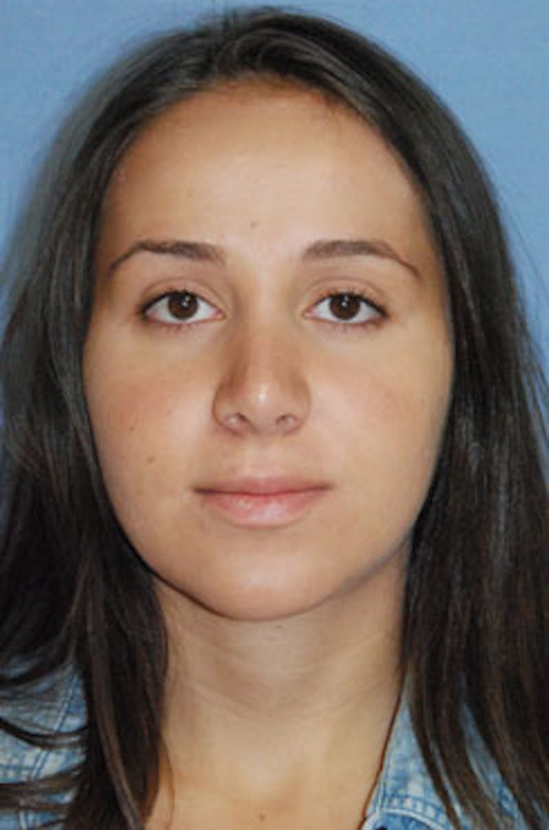 Asian Rhinoplasty Before & After Gallery - Patient 322460 - Image 2