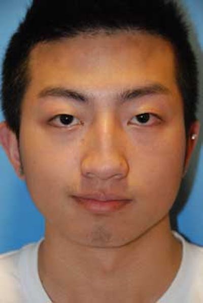 Rhinoplasty Before & After Gallery - Patient 387187 - Image 1