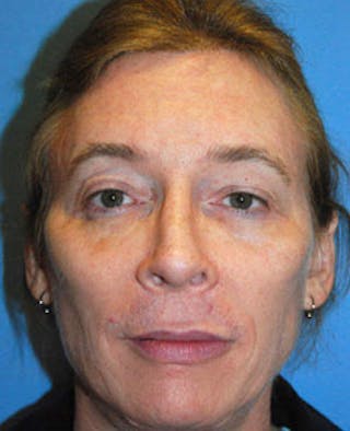 Facial Implants Before & After Gallery - Patient 228729 - Image 2