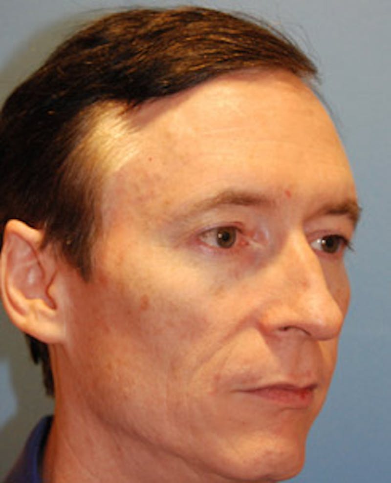 Brow Lift Before & After Gallery - Patient 207012 - Image 3