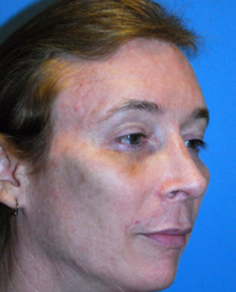Brow Lift Before & After Gallery - Patient 207012 - Image 4