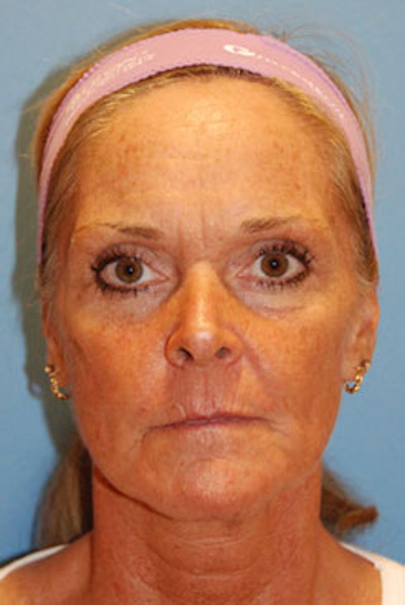 YoungVitalizer Before & After Gallery - Patient 164721 - Image 1