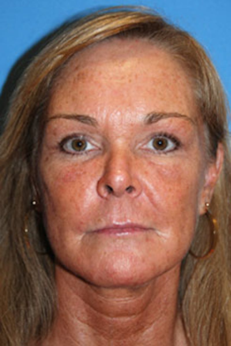 YoungVitalizer Before & After Gallery - Patient 164721 - Image 2