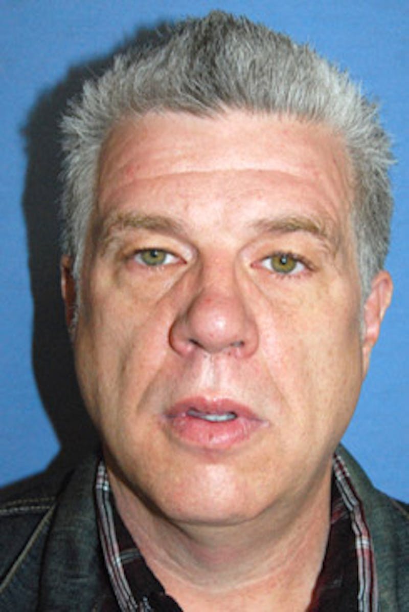 Brow Lift Before & After Gallery - Patient 317072 - Image 1