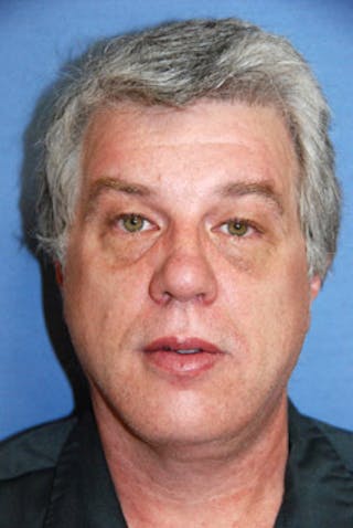 Brow Lift Before & After Gallery - Patient 317072 - Image 2