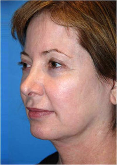 Eye Lift Before & After Gallery - Patient 123754 - Image 1