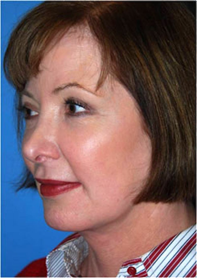 Eye Lift Before & After Gallery - Patient 123754 - Image 2