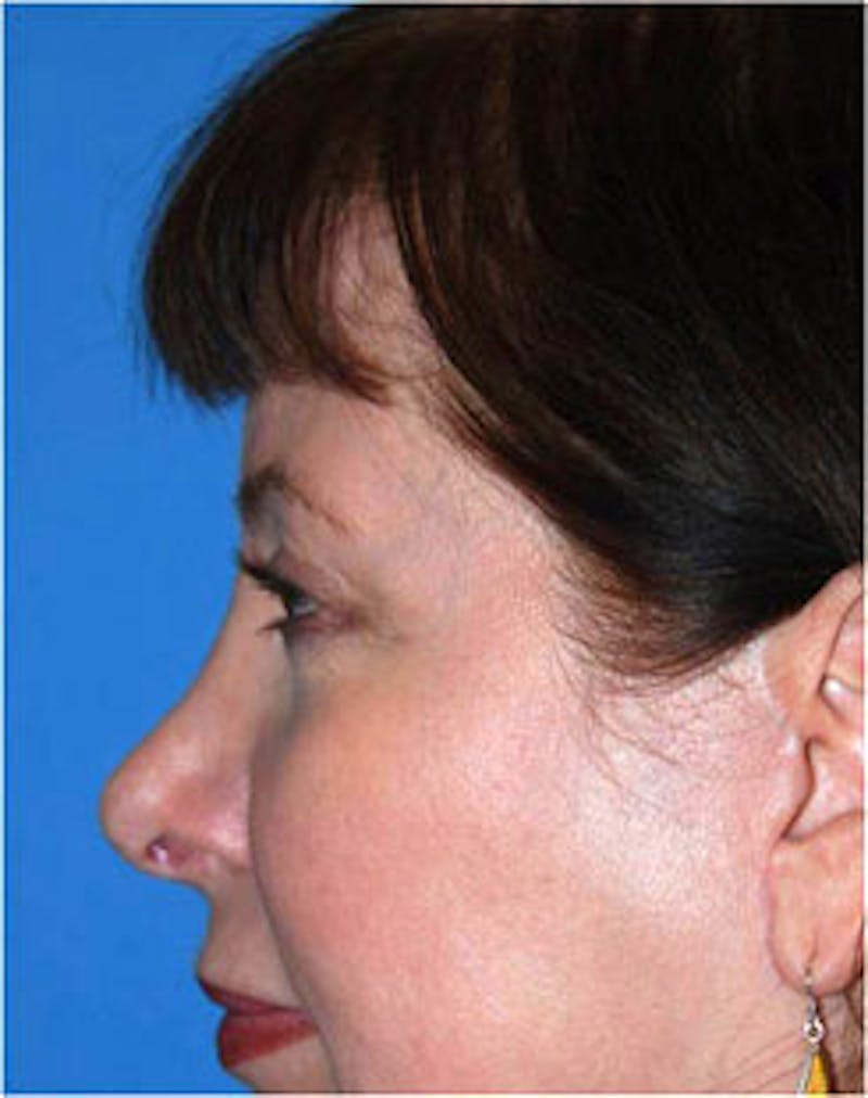 Eye Lift Before & After Gallery - Patient 123754 - Image 3