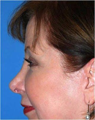 Eye Lift Before & After Gallery - Patient 123754 - Image 4