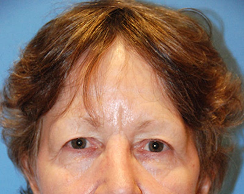 Eye Lift Before & After Gallery - Patient 187665 - Image 1