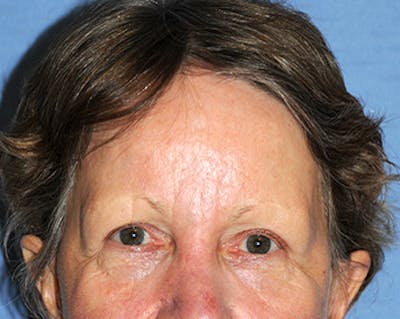 Eye Lift Before & After Gallery - Patient 187665 - Image 2