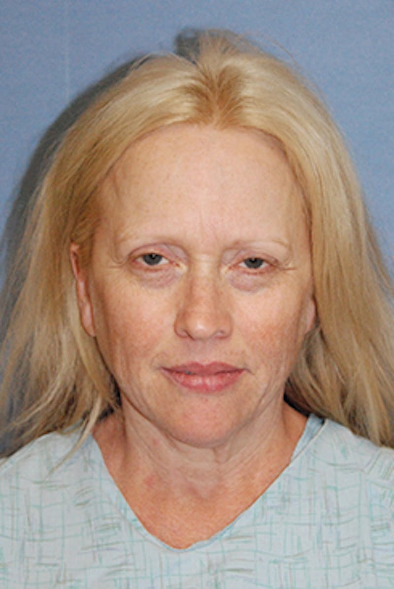 Brow Lift Before & After Gallery - Patient 377057 - Image 1
