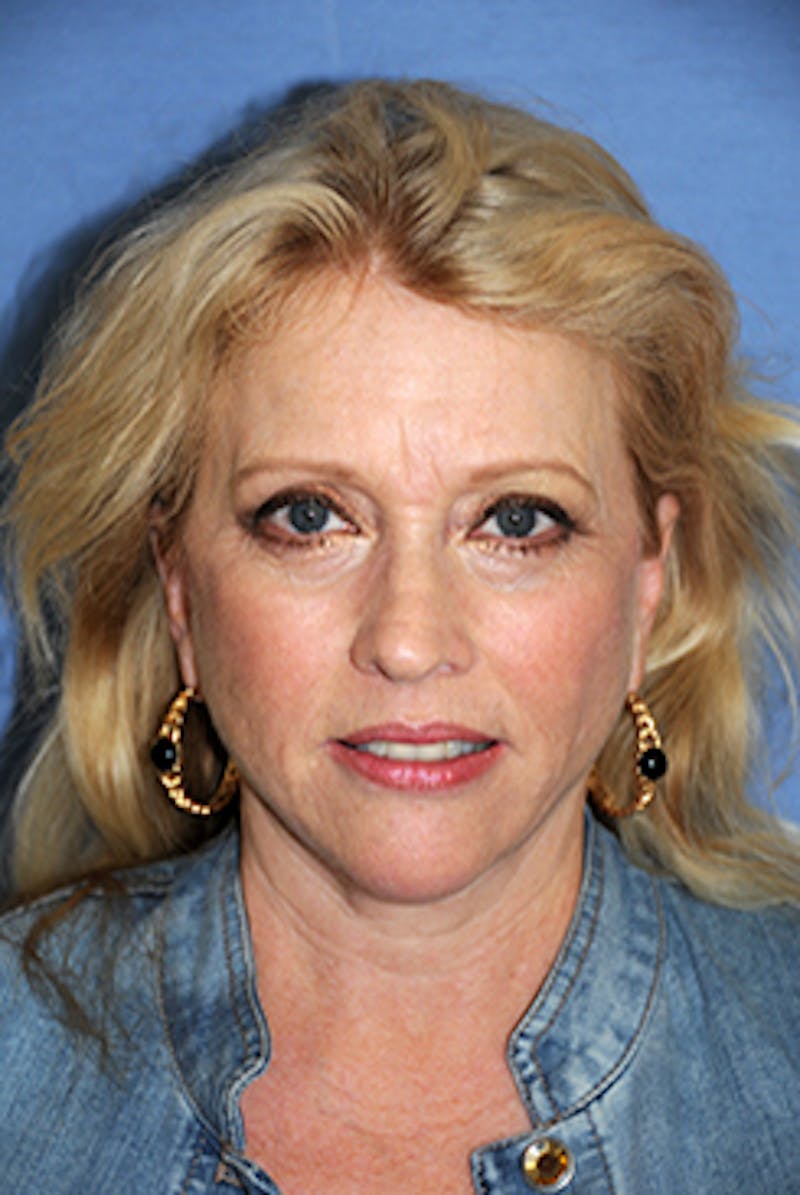 Brow Lift Before & After Gallery - Patient 377057 - Image 2