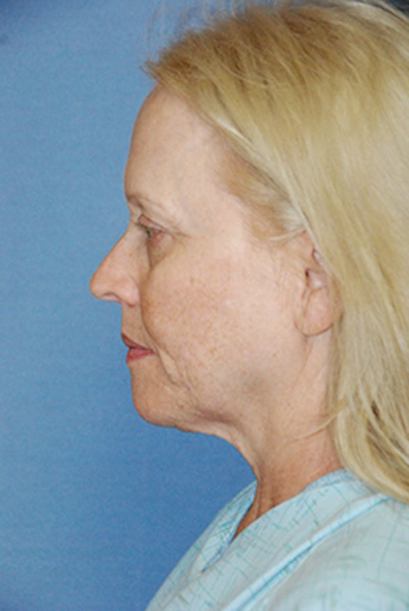 Brow Lift Before & After Gallery - Patient 377057 - Image 3