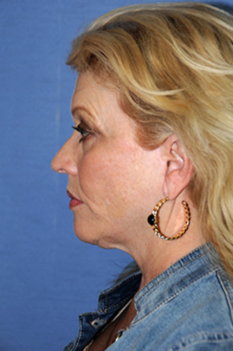 Brow Lift Before & After Gallery - Patient 377057 - Image 4