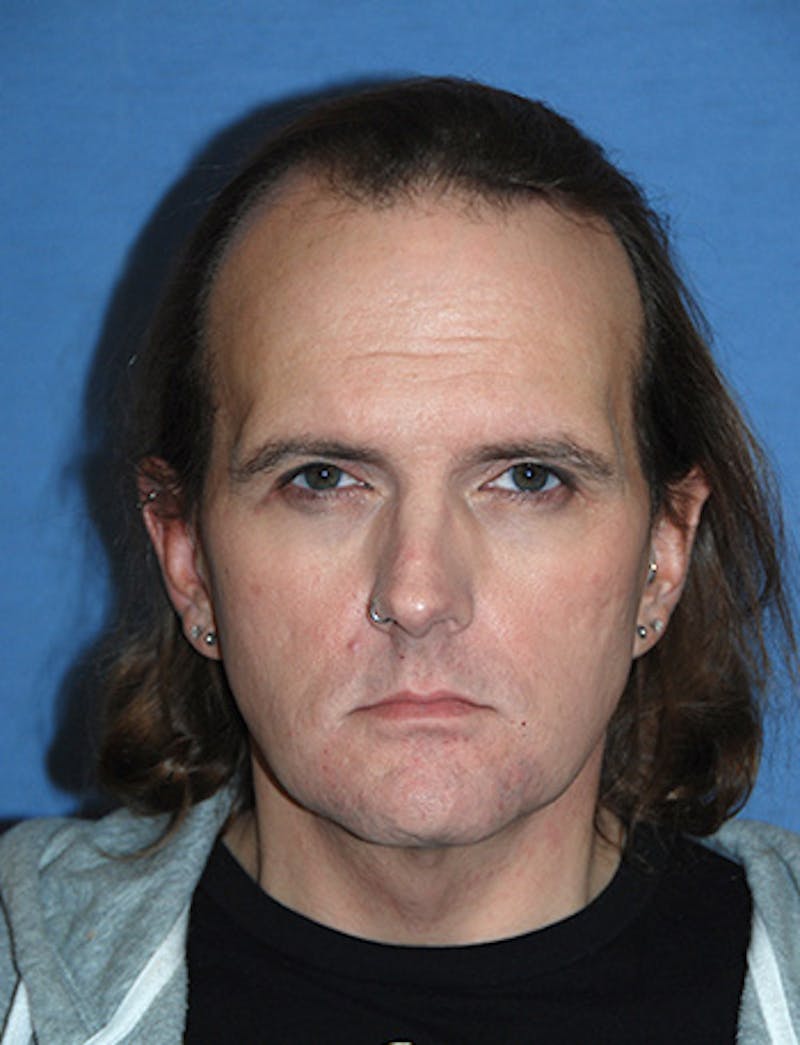 Transgender Surgery Before & After Gallery - Patient 263469 - Image 1