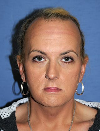 Transgender Surgery Before & After Gallery - Patient 263469 - Image 2