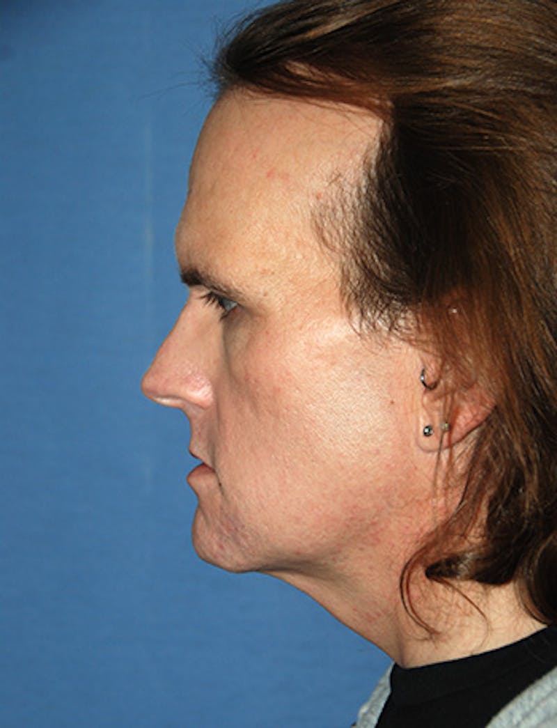 Transgender Surgery Before & After Gallery - Patient 263469 - Image 3