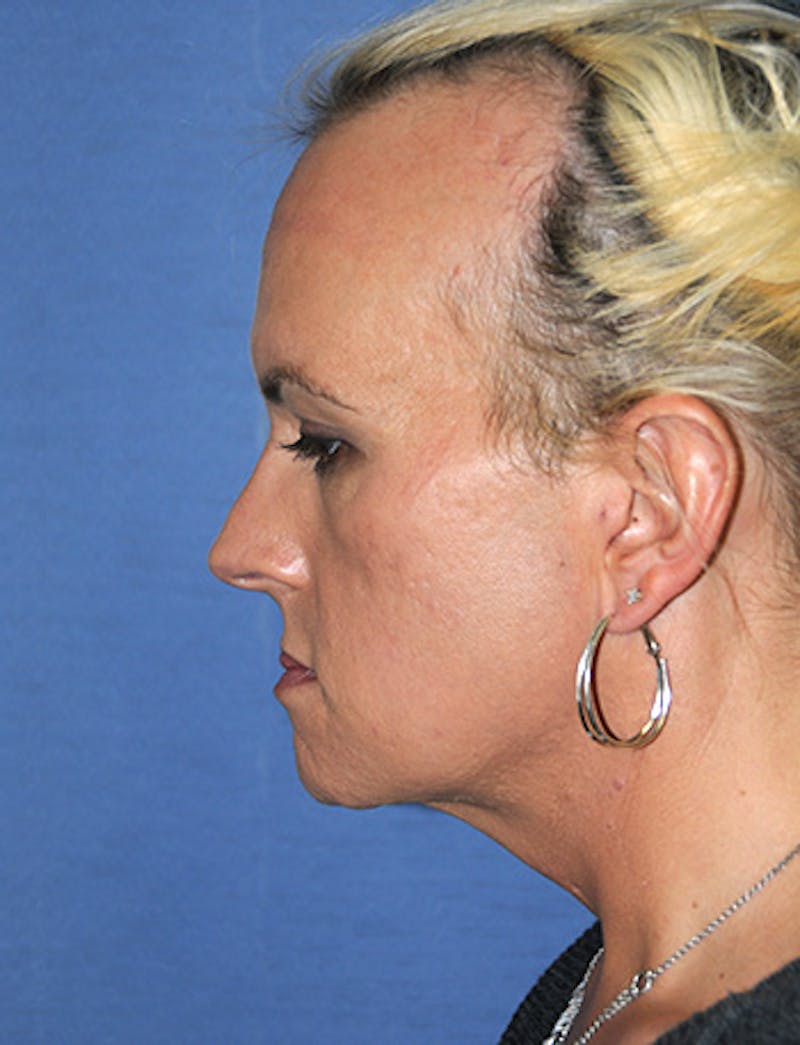Transgender Surgery Before & After Gallery - Patient 263469 - Image 4