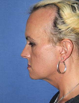 Transgender Surgery Before & After Gallery - Patient 263469 - Image 4