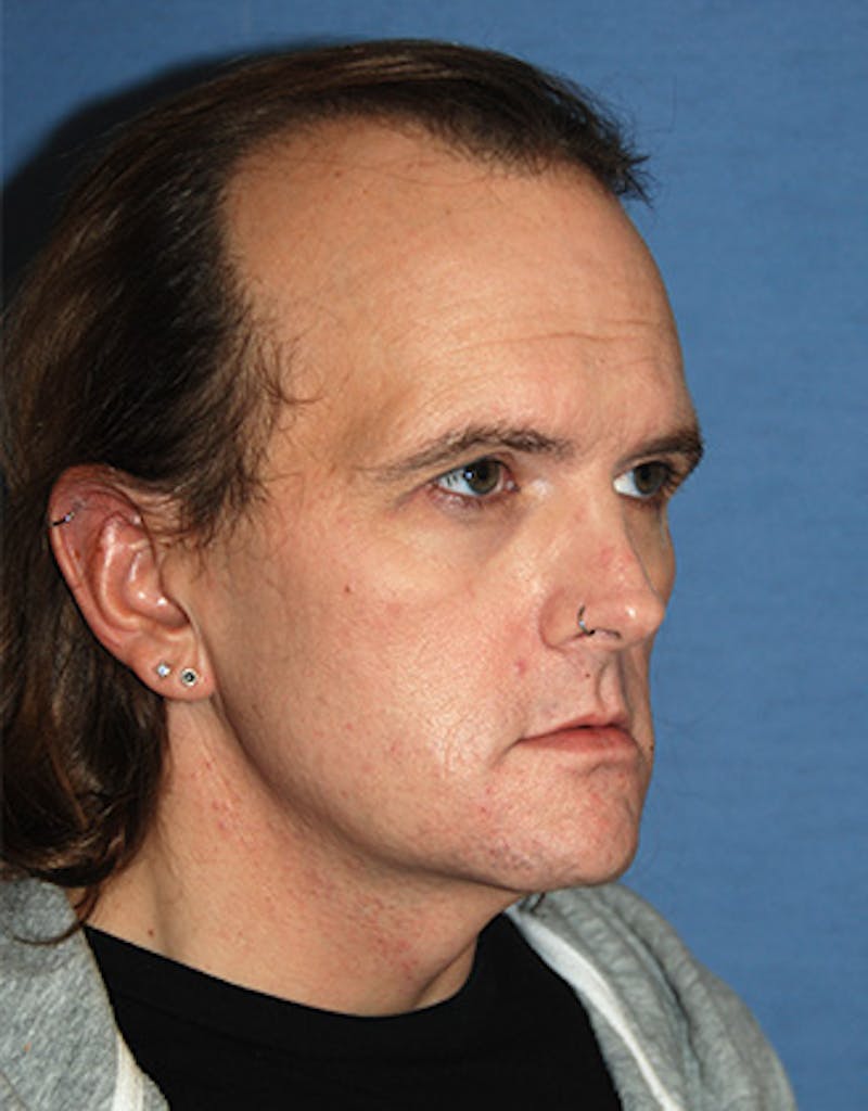 Chin Implant Reshaping Before & After Gallery - Patient 362122 - Image 7