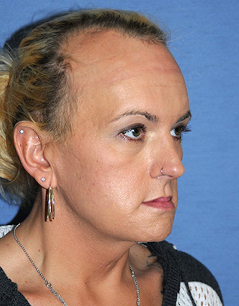 Chin Implant Reshaping Before & After Gallery - Patient 362122 - Image 8