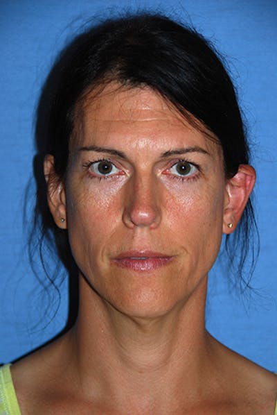 Transgender Surgery Before & After Gallery - Patient 270382 - Image 1