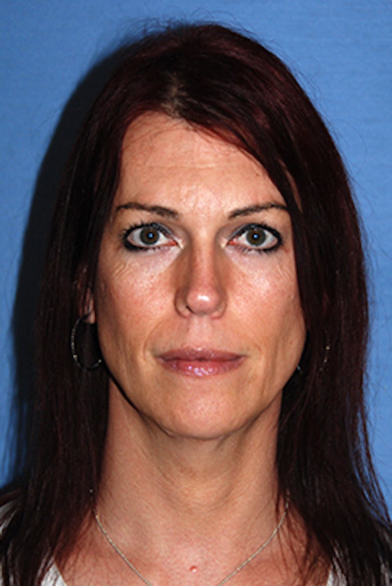 Brow Lift Before & After Gallery - Patient 220561 - Image 2