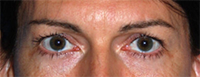Brow Lift Before & After Gallery - Patient 220561 - Image 3