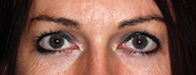 Brow Lift Before & After Gallery - Patient 220561 - Image 4