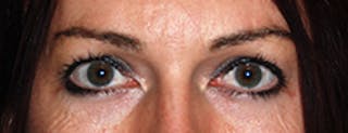 Brow Lift Before & After Gallery - Patient 220561 - Image 4
